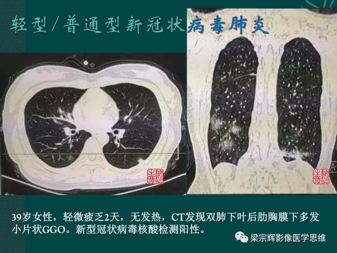 【PPT】新型冠状病毒（COVID-19）肺炎概念与CT表现