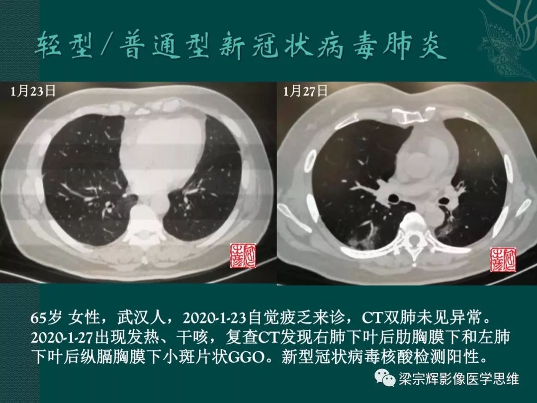 【PPT】新型冠状病毒（COVID-19）肺炎概念与CT表现