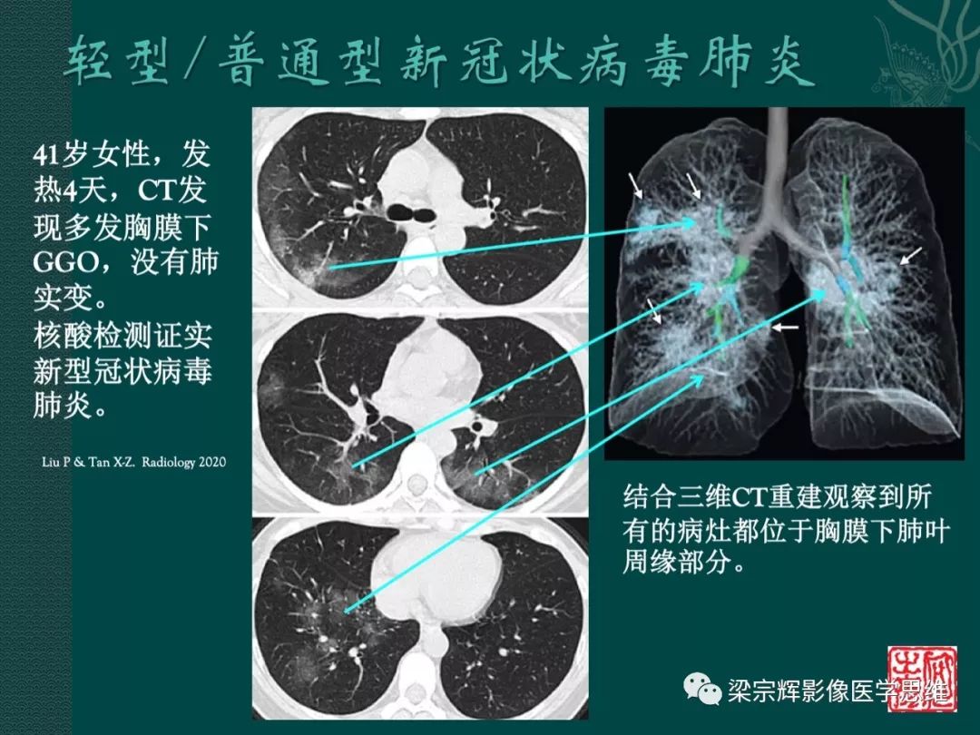 【PPT】新型冠状病毒（COVID-19）肺炎概念与CT表现