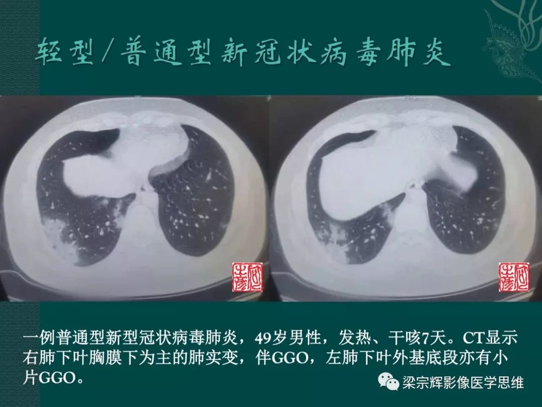 【PPT】新型冠状病毒（COVID-19）肺炎概念与CT表现