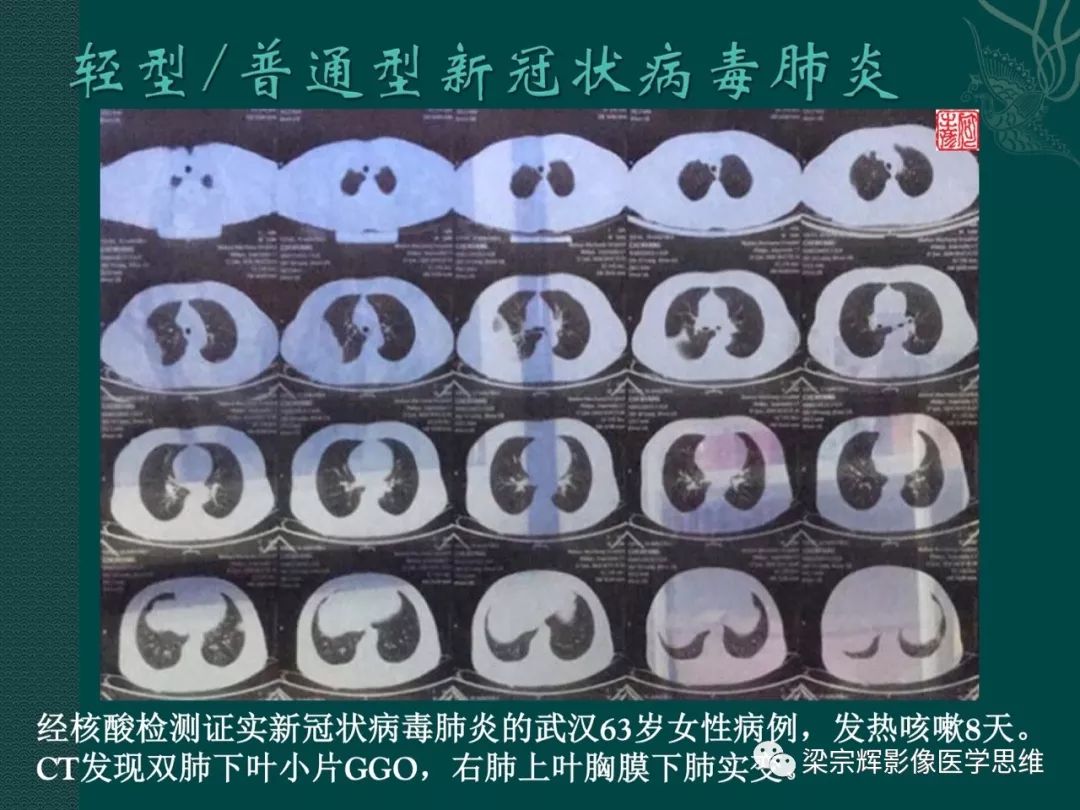 【PPT】新型冠状病毒（COVID-19）肺炎概念与CT表现
