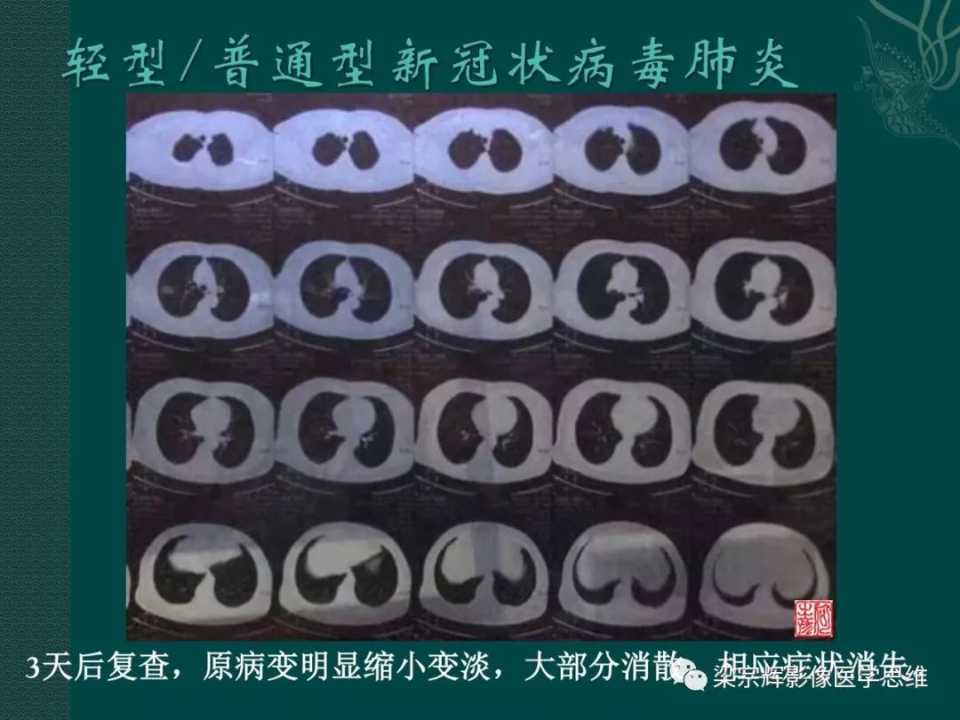 【PPT】新型冠状病毒（COVID-19）肺炎概念与CT表现