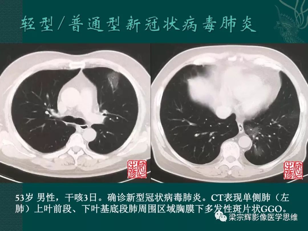 【PPT】新型冠状病毒（COVID-19）肺炎概念与CT表现