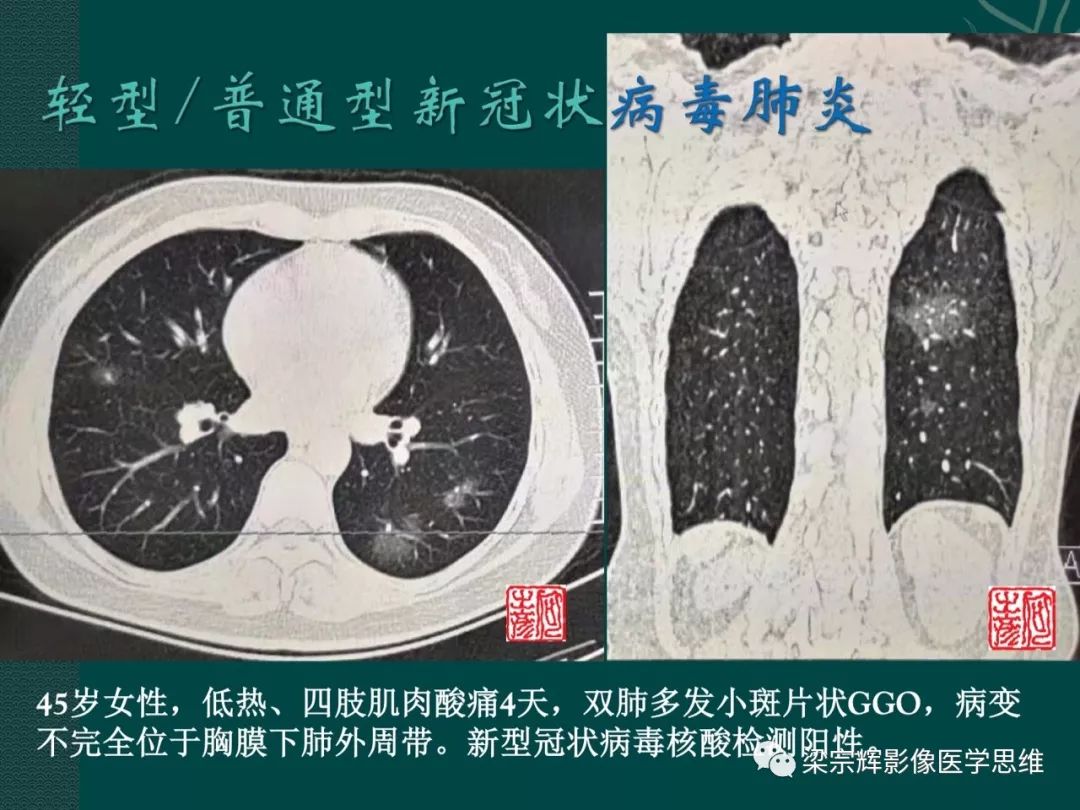 【PPT】新型冠状病毒（COVID-19）肺炎概念与CT表现