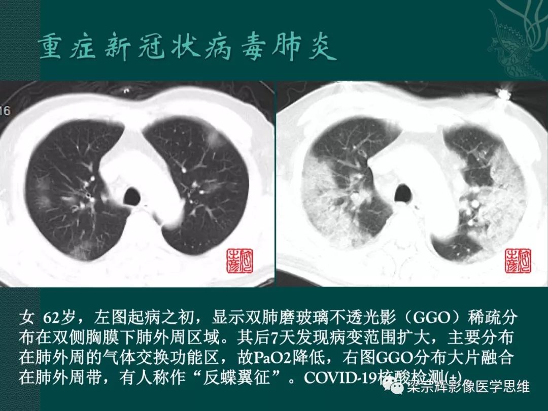 【PPT】新型冠状病毒（COVID-19）肺炎概念与CT表现