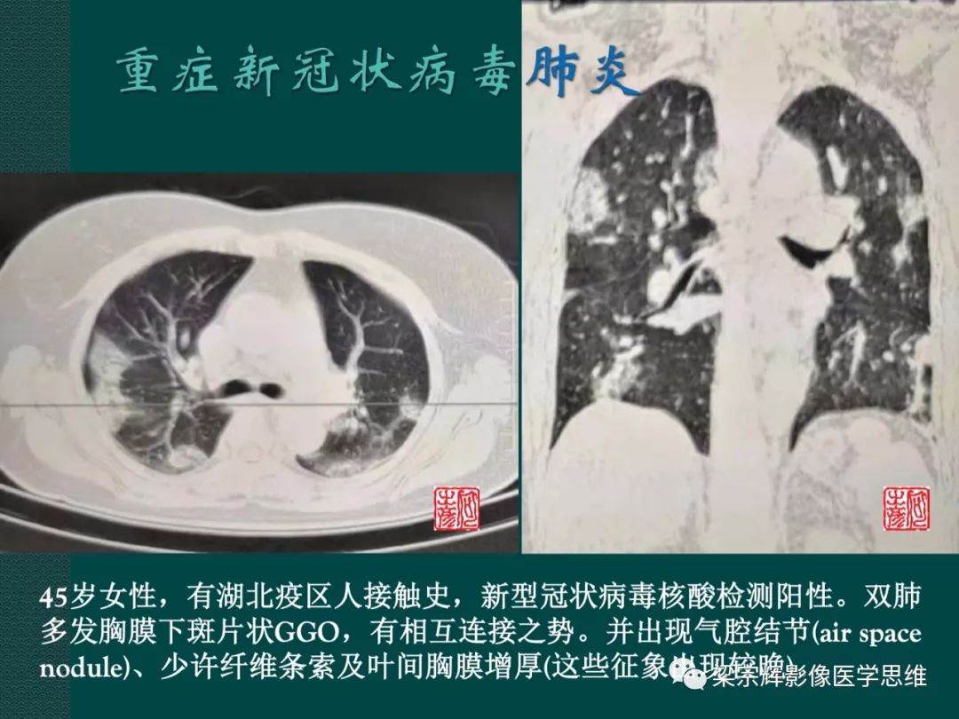 【PPT】新型冠状病毒（COVID-19）肺炎概念与CT表现