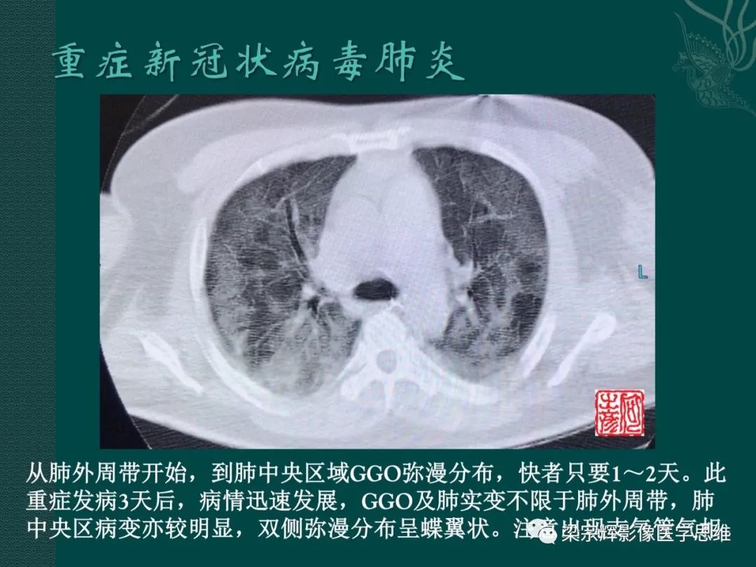 【PPT】新型冠状病毒（COVID-19）肺炎概念与CT表现