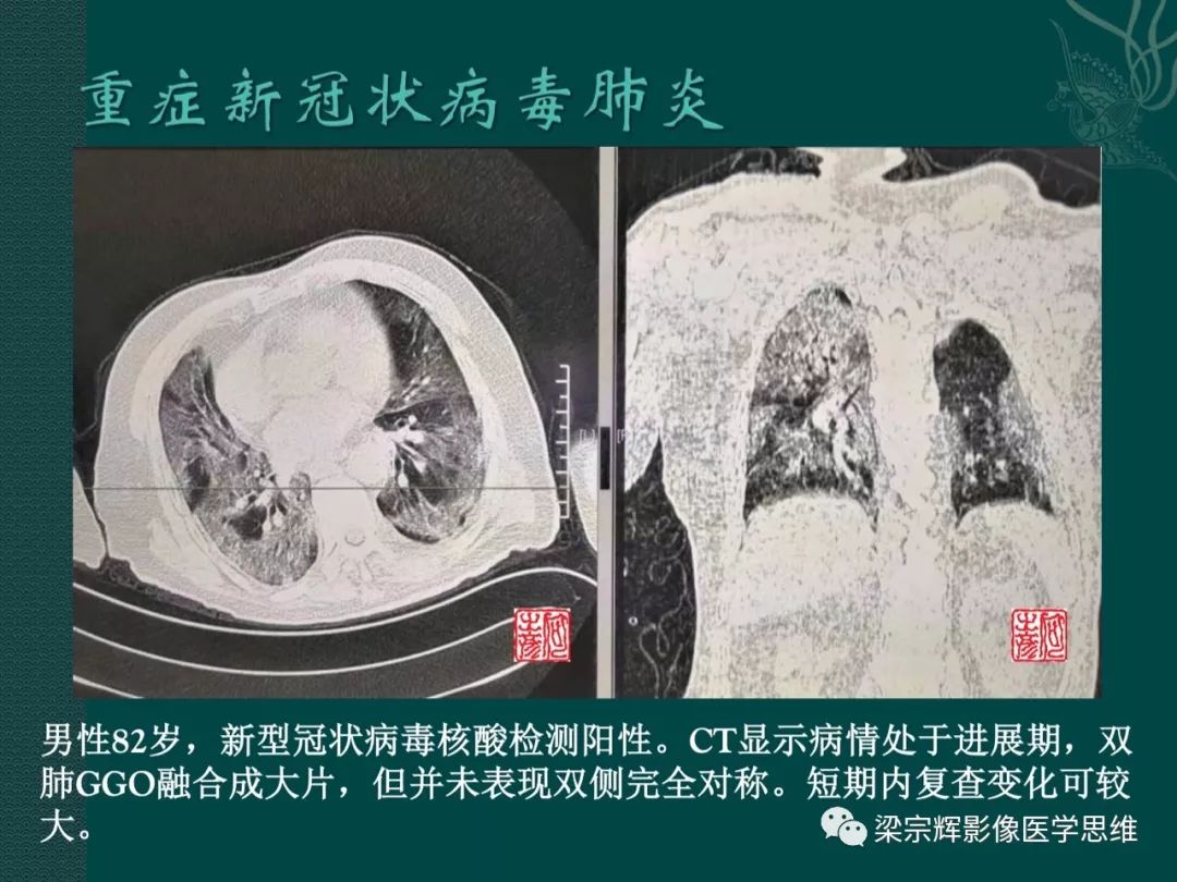 【PPT】新型冠状病毒（COVID-19）肺炎概念与CT表现