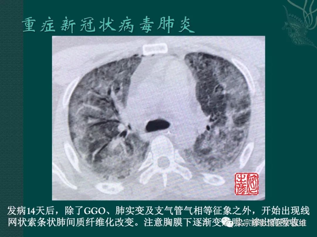 【PPT】新型冠状病毒（COVID-19）肺炎概念与CT表现
