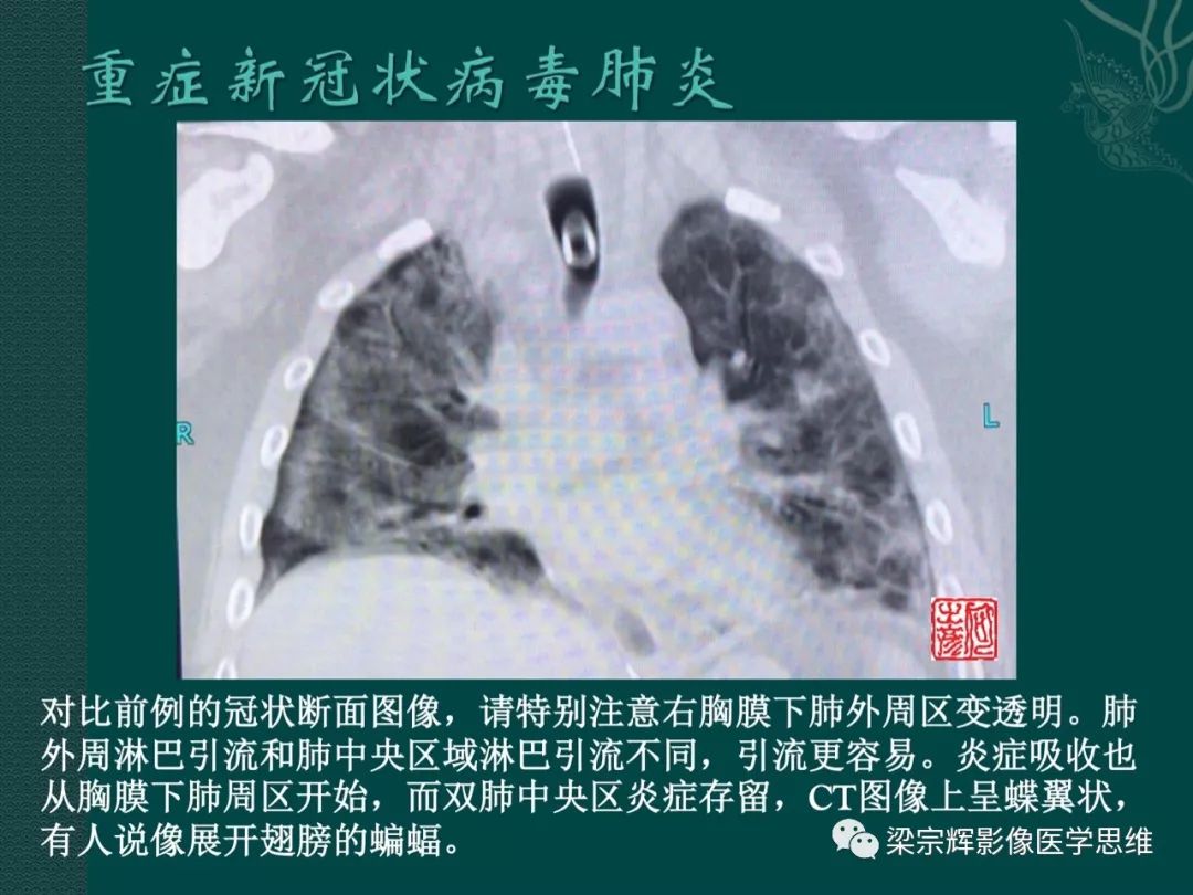 【PPT】新型冠状病毒（COVID-19）肺炎概念与CT表现