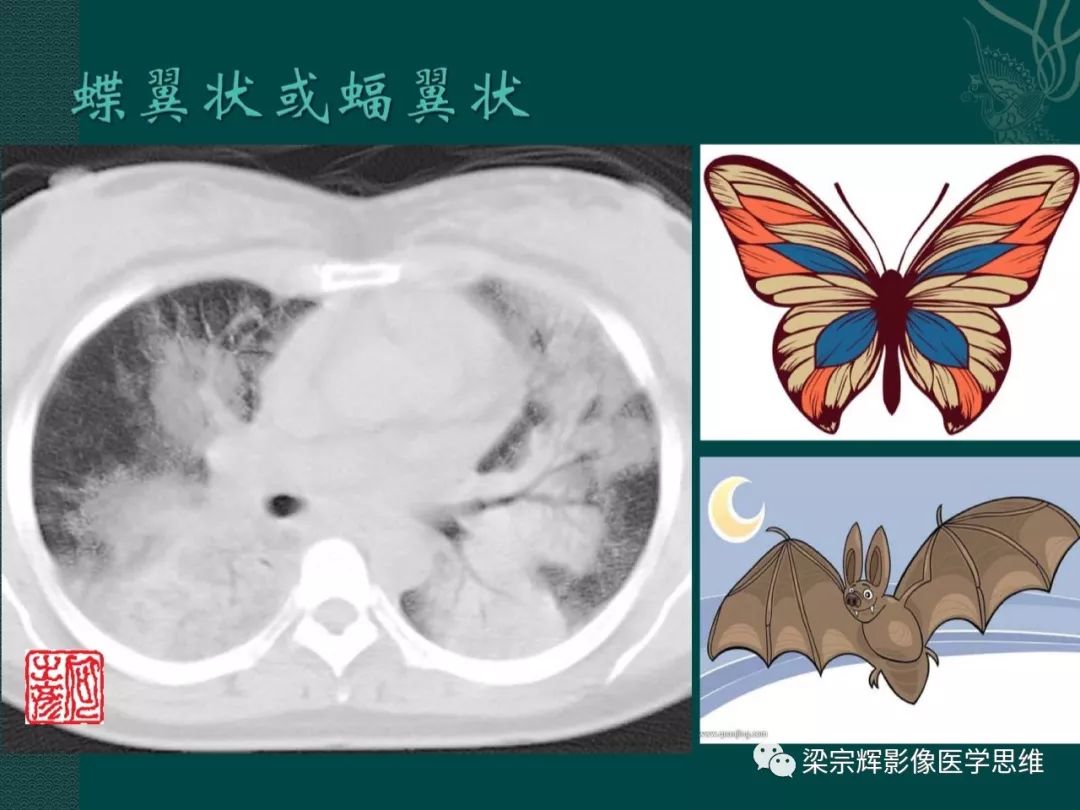 【PPT】新型冠状病毒（COVID-19）肺炎概念与CT表现