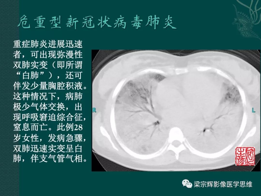 【PPT】新型冠状病毒（COVID-19）肺炎概念与CT表现