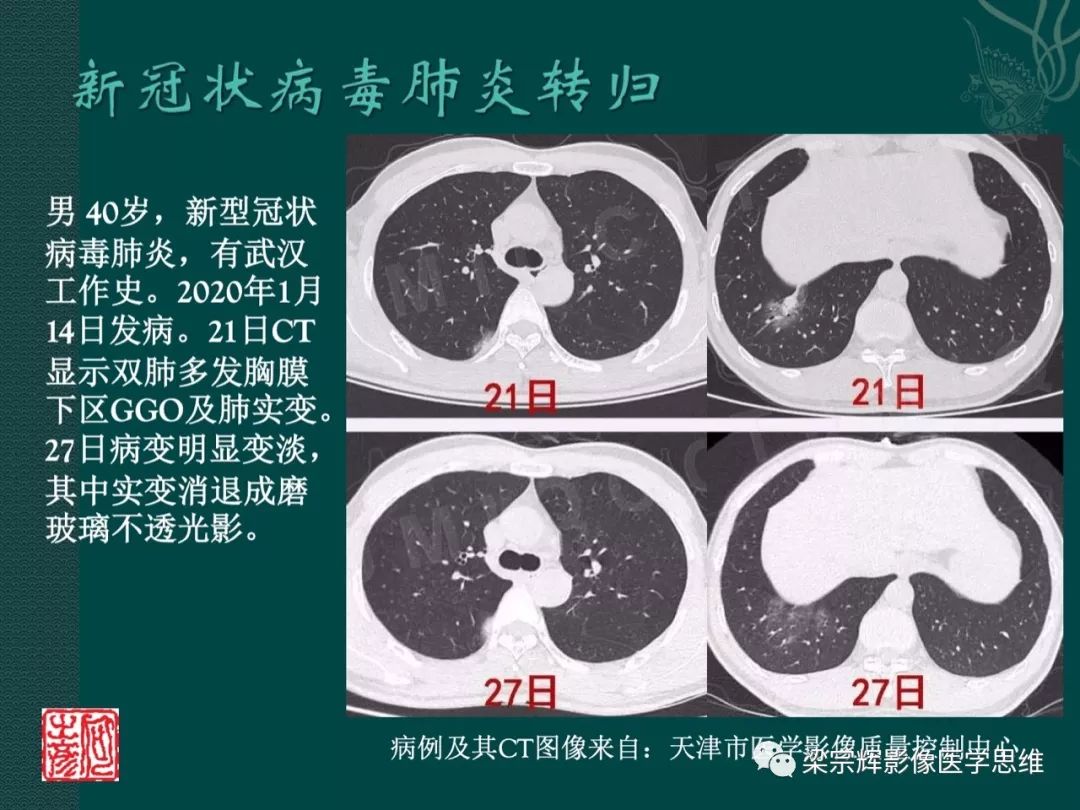 【PPT】新型冠状病毒（COVID-19）肺炎概念与CT表现