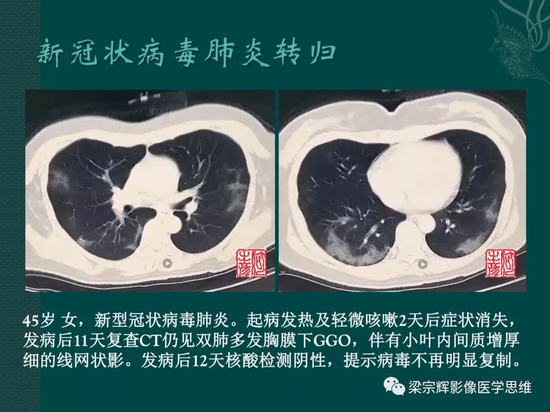 【PPT】新型冠状病毒（COVID-19）肺炎概念与CT表现