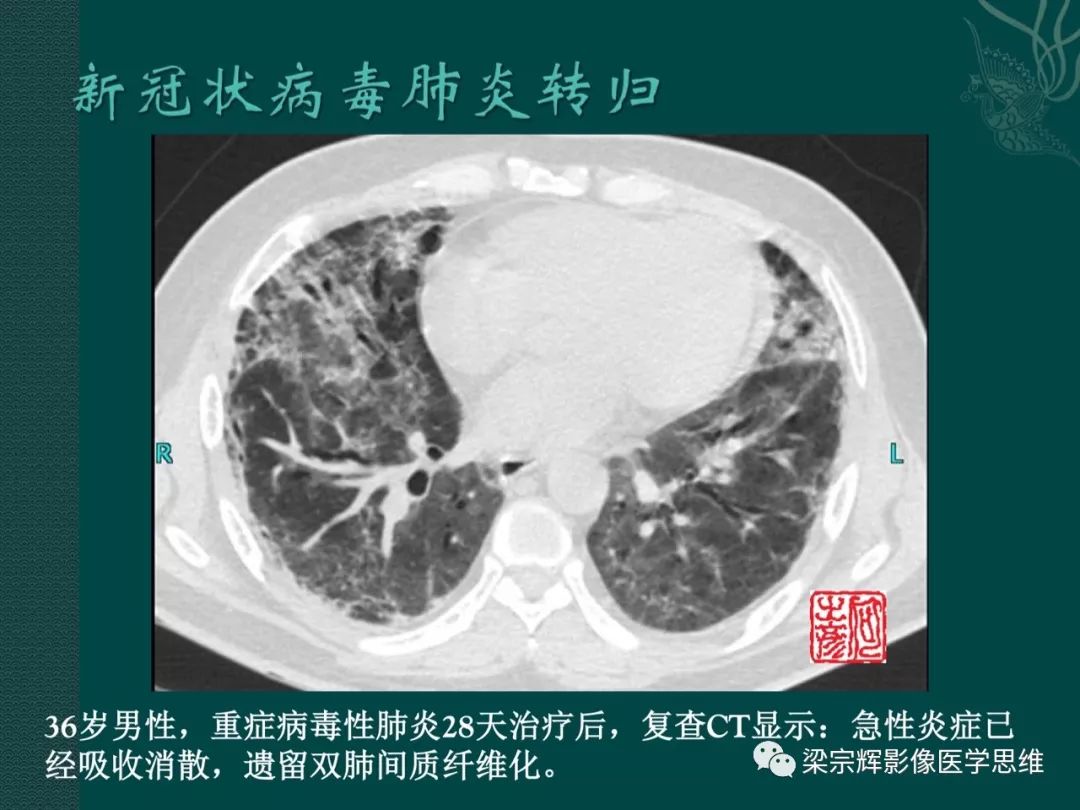 【PPT】新型冠状病毒（COVID-19）肺炎概念与CT表现