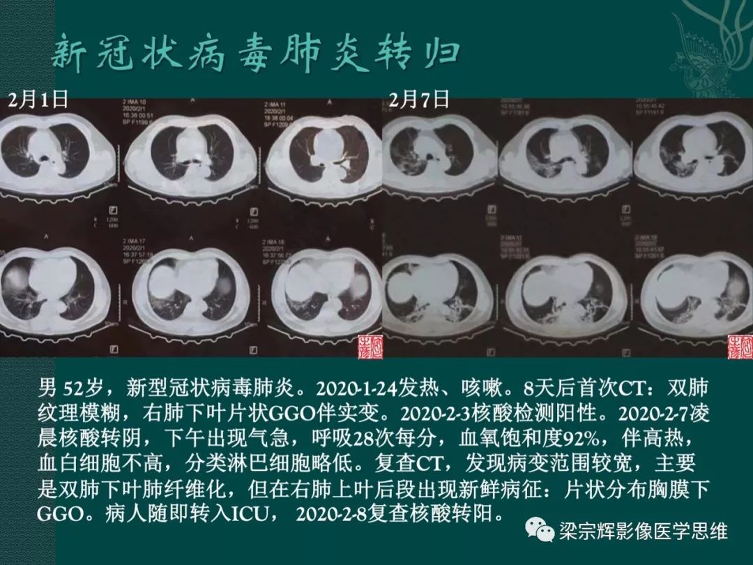【PPT】新型冠状病毒（COVID-19）肺炎概念与CT表现