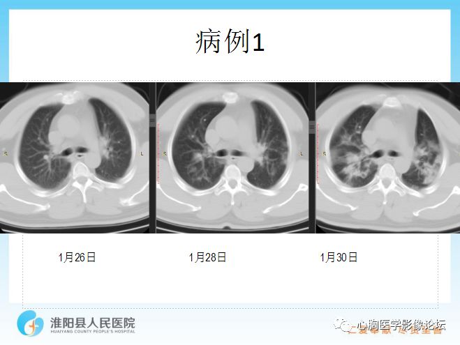 【PPT】新型冠状病毒肺炎