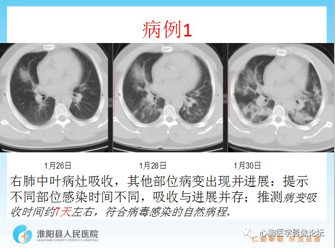 【PPT】新型冠状病毒肺炎