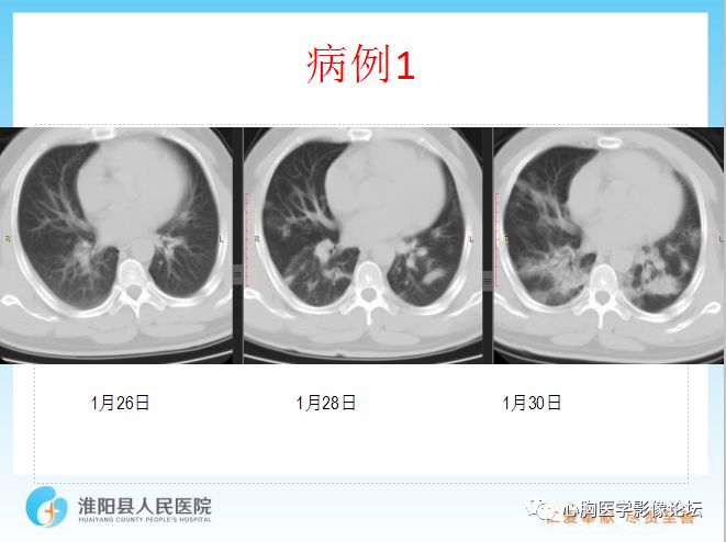 【PPT】新型冠状病毒肺炎