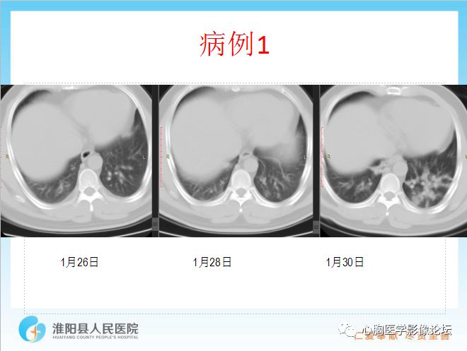 【PPT】新型冠状病毒肺炎