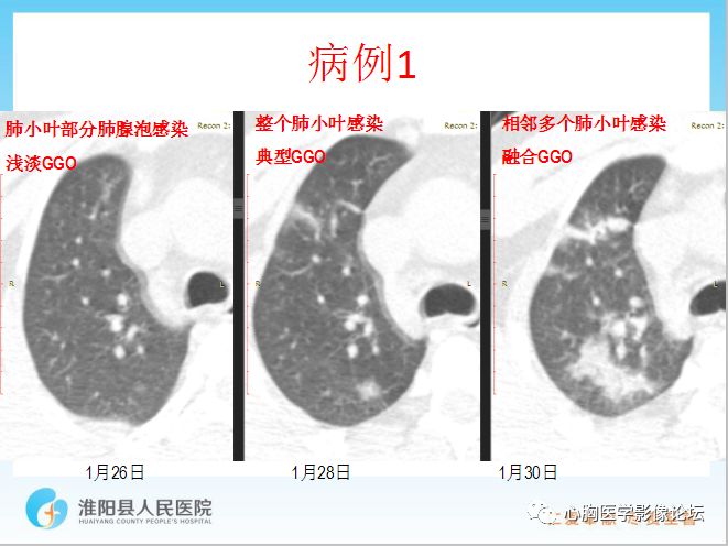 【PPT】新型冠状病毒肺炎