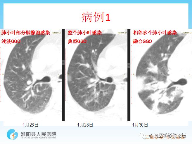 【PPT】新型冠状病毒肺炎