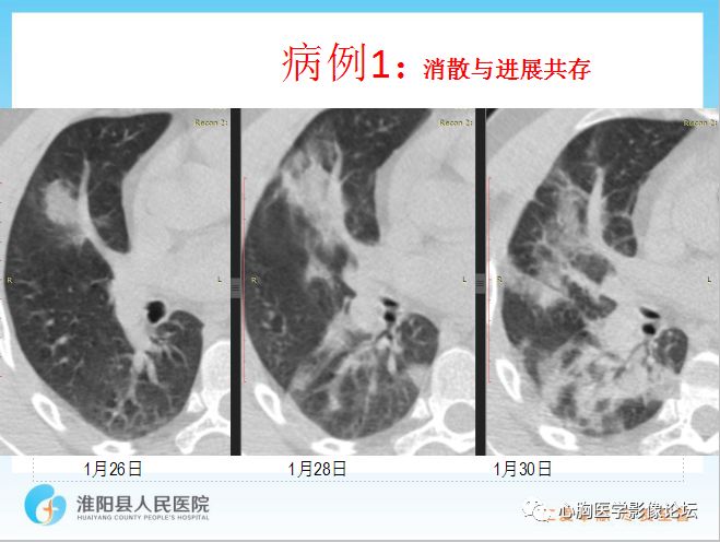 【PPT】新型冠状病毒肺炎