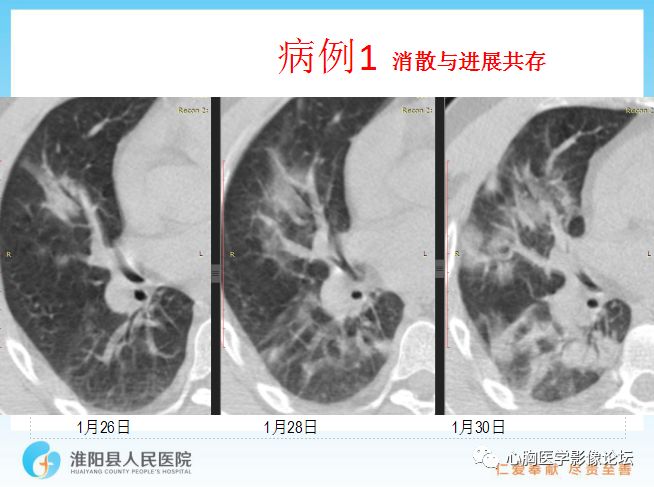 【PPT】新型冠状病毒肺炎