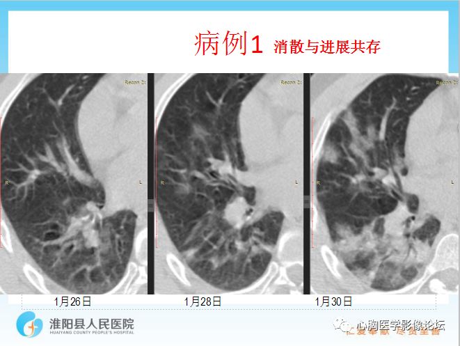 【PPT】新型冠状病毒肺炎
