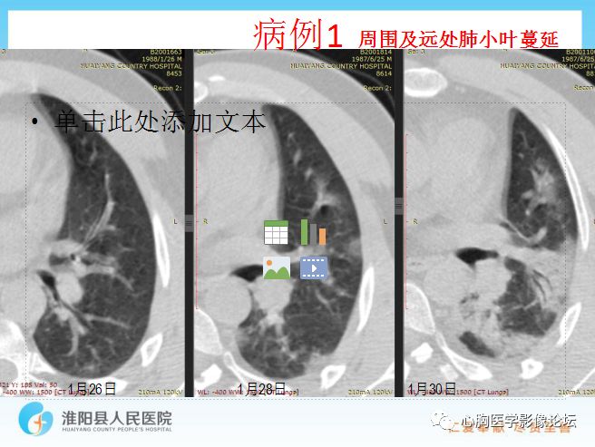 【PPT】新型冠状病毒肺炎