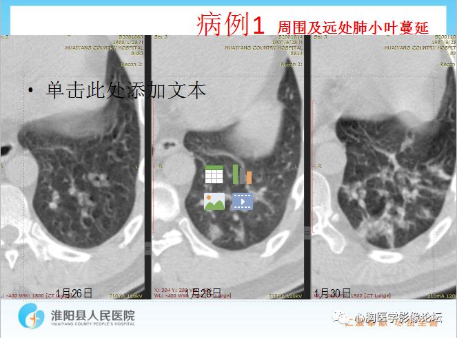 【PPT】新型冠状病毒肺炎