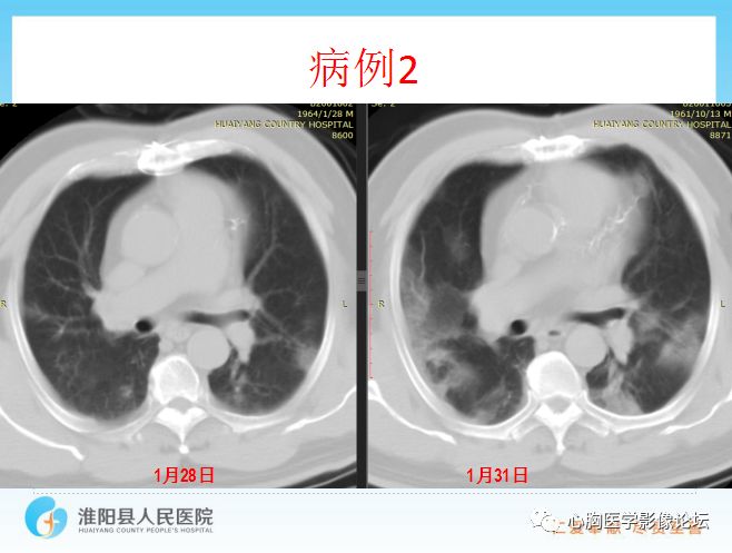 【PPT】新型冠状病毒肺炎