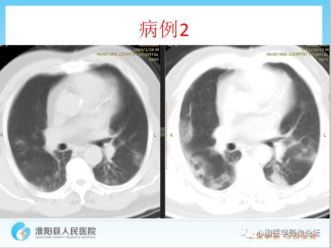 【PPT】新型冠状病毒肺炎