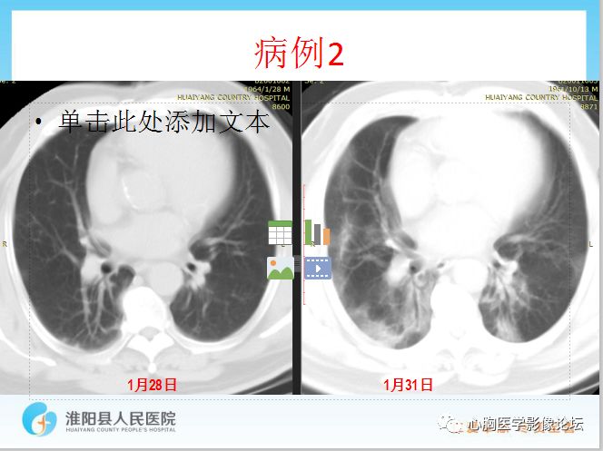 【PPT】新型冠状病毒肺炎