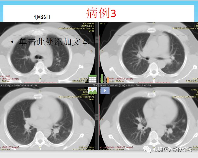【PPT】新型冠状病毒肺炎