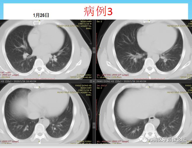 【PPT】新型冠状病毒肺炎