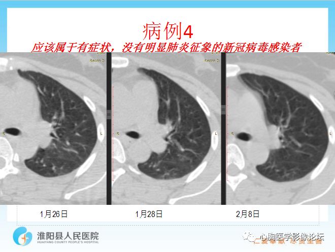 【PPT】新型冠状病毒肺炎