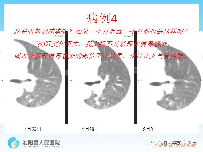 【PPT】新型冠状病毒肺炎