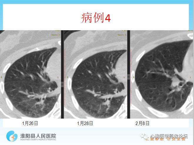 【PPT】新型冠状病毒肺炎