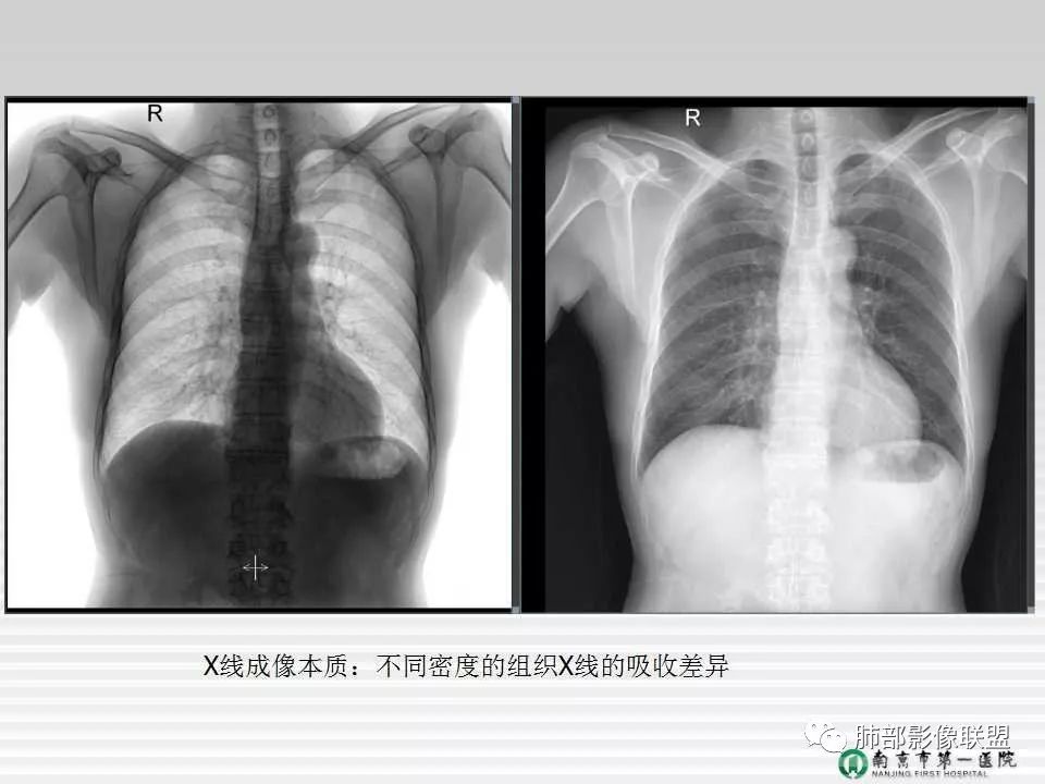 【PPT】胸片中的界与线——识别隐匿者与伪装者