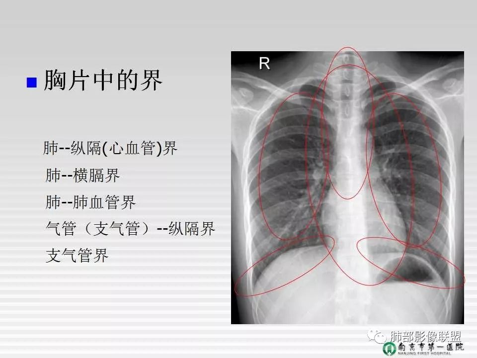 【PPT】胸片中的界与线——识别隐匿者与伪装者