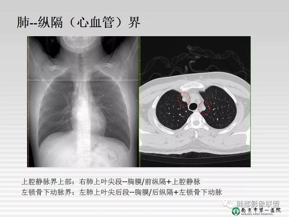 【PPT】胸片中的界与线——识别隐匿者与伪装者