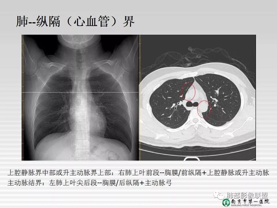 【PPT】胸片中的界与线——识别隐匿者与伪装者