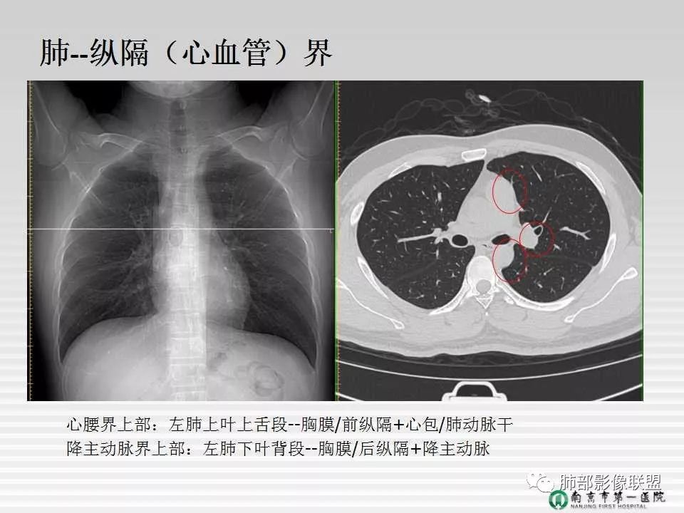 【PPT】胸片中的界与线——识别隐匿者与伪装者