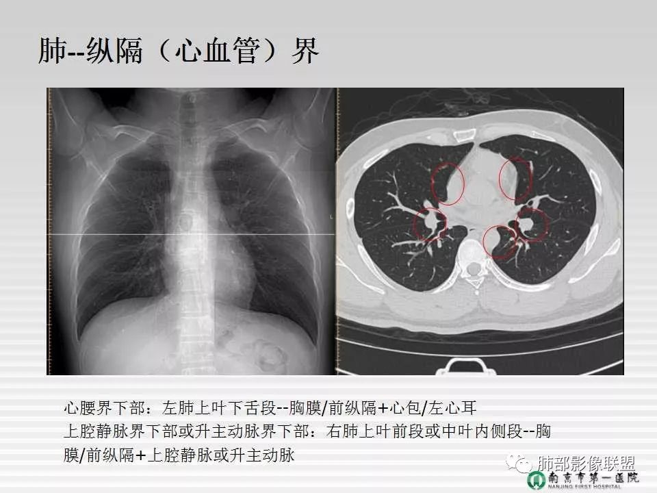 【PPT】胸片中的界与线——识别隐匿者与伪装者