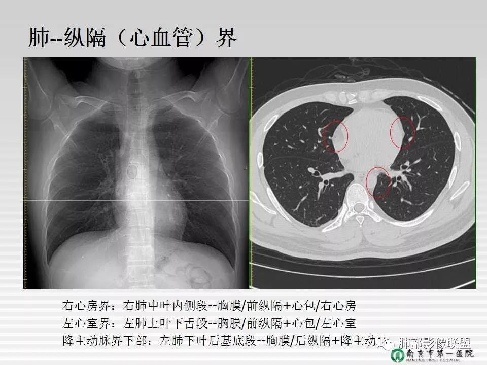 【PPT】胸片中的界与线——识别隐匿者与伪装者