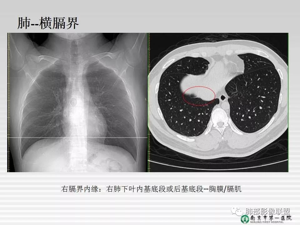 【PPT】胸片中的界与线——识别隐匿者与伪装者