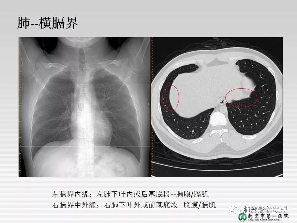 【PPT】胸片中的界与线——识别隐匿者与伪装者