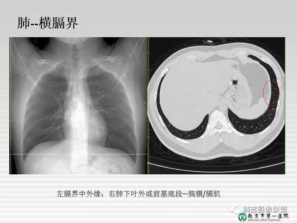 【PPT】胸片中的界与线——识别隐匿者与伪装者