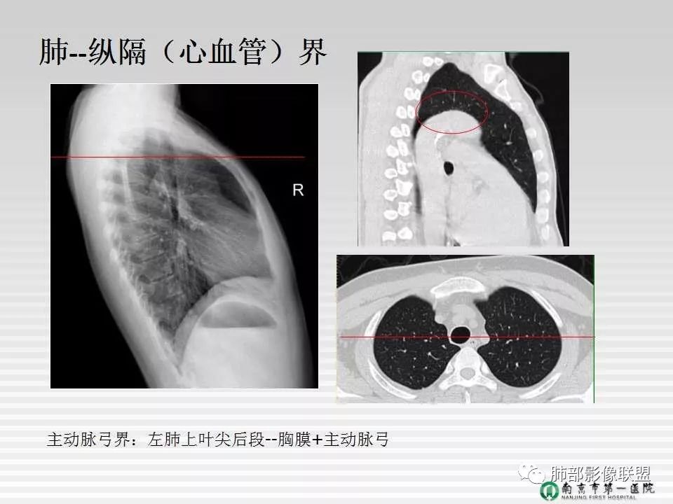 【PPT】胸片中的界与线——识别隐匿者与伪装者